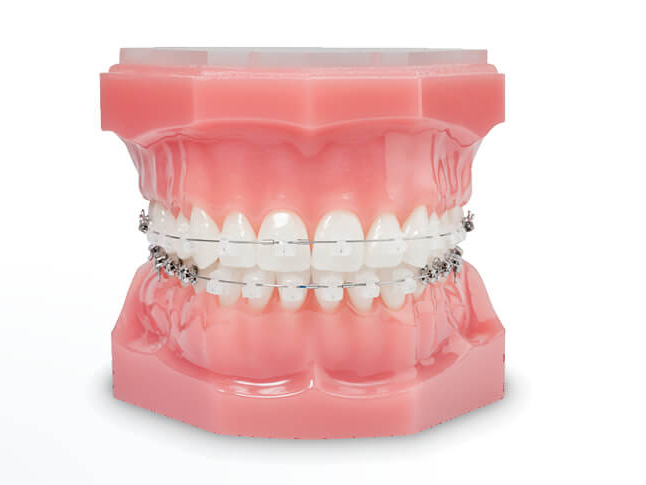 Damon Clear Brackets bei KFO-Herten